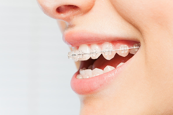 ワイヤー矯正（マルチブラケット矯正）