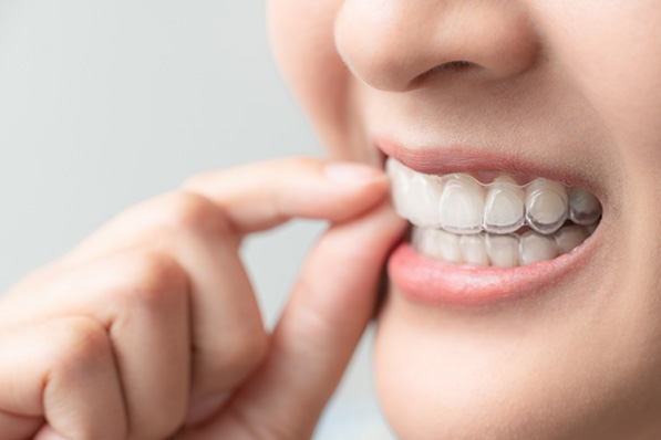 マウスピース型矯正装置