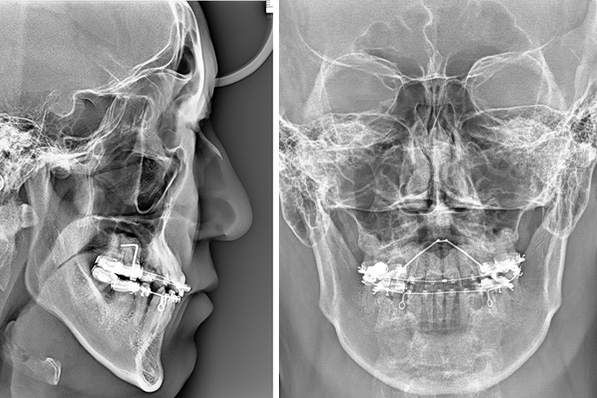 セファロによる骨格分析