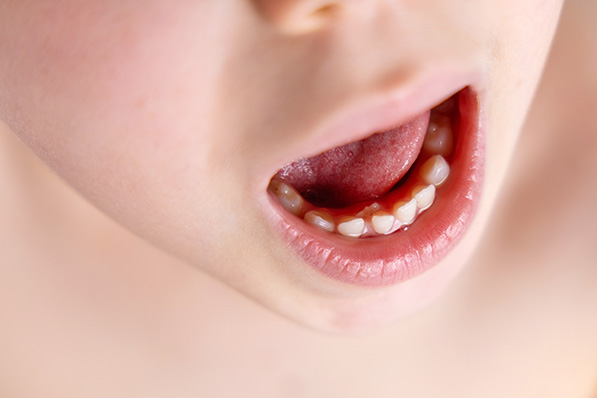 MFT（口腔筋機能療法）