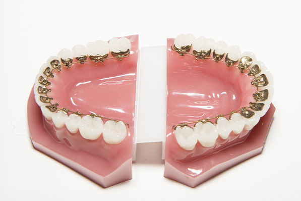 フルリンガル矯正