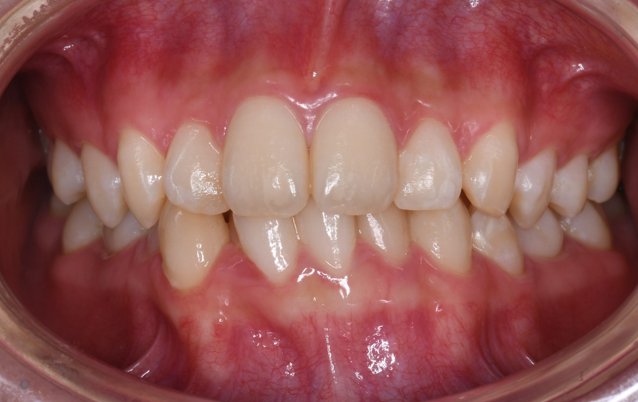 下の歯のガタつきを治したい 治療前