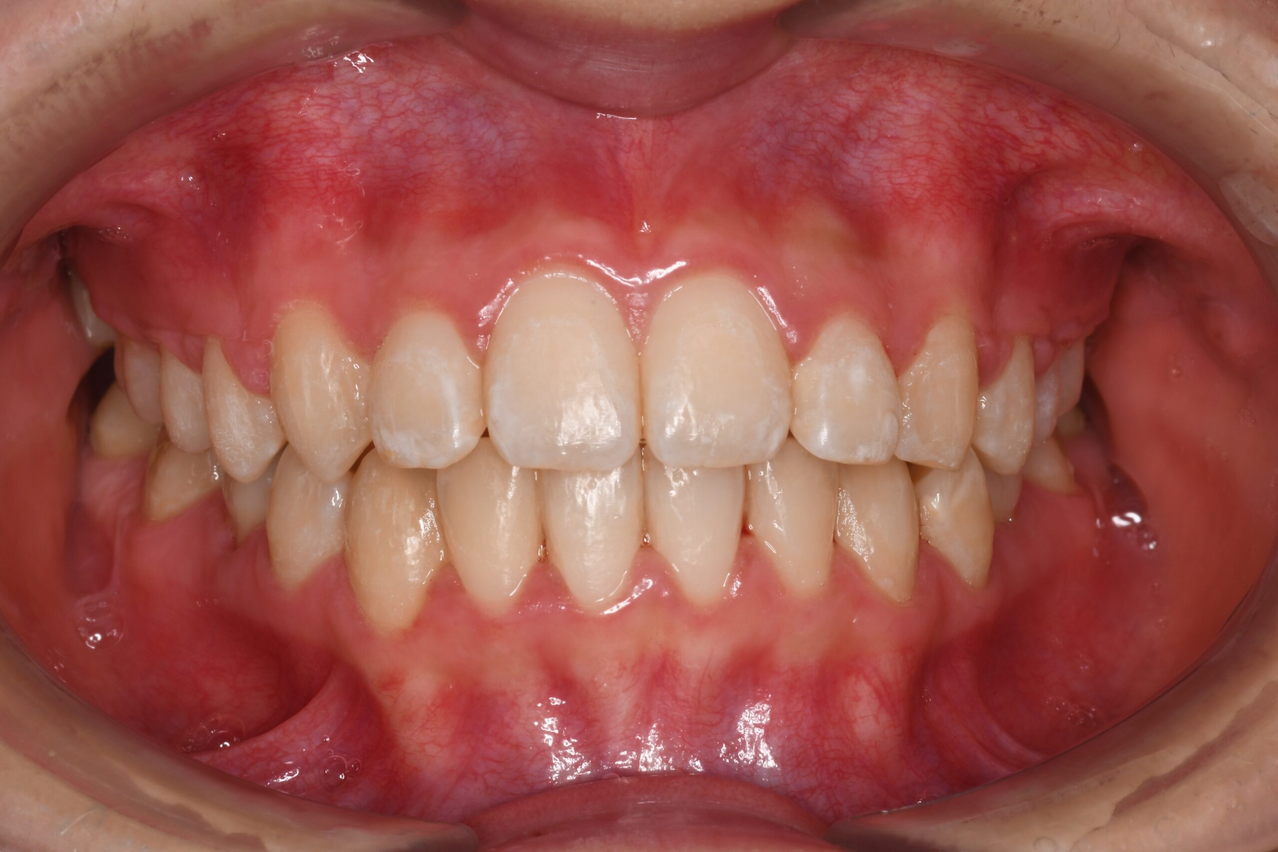 下の歯のガタつきを治したい 治療後