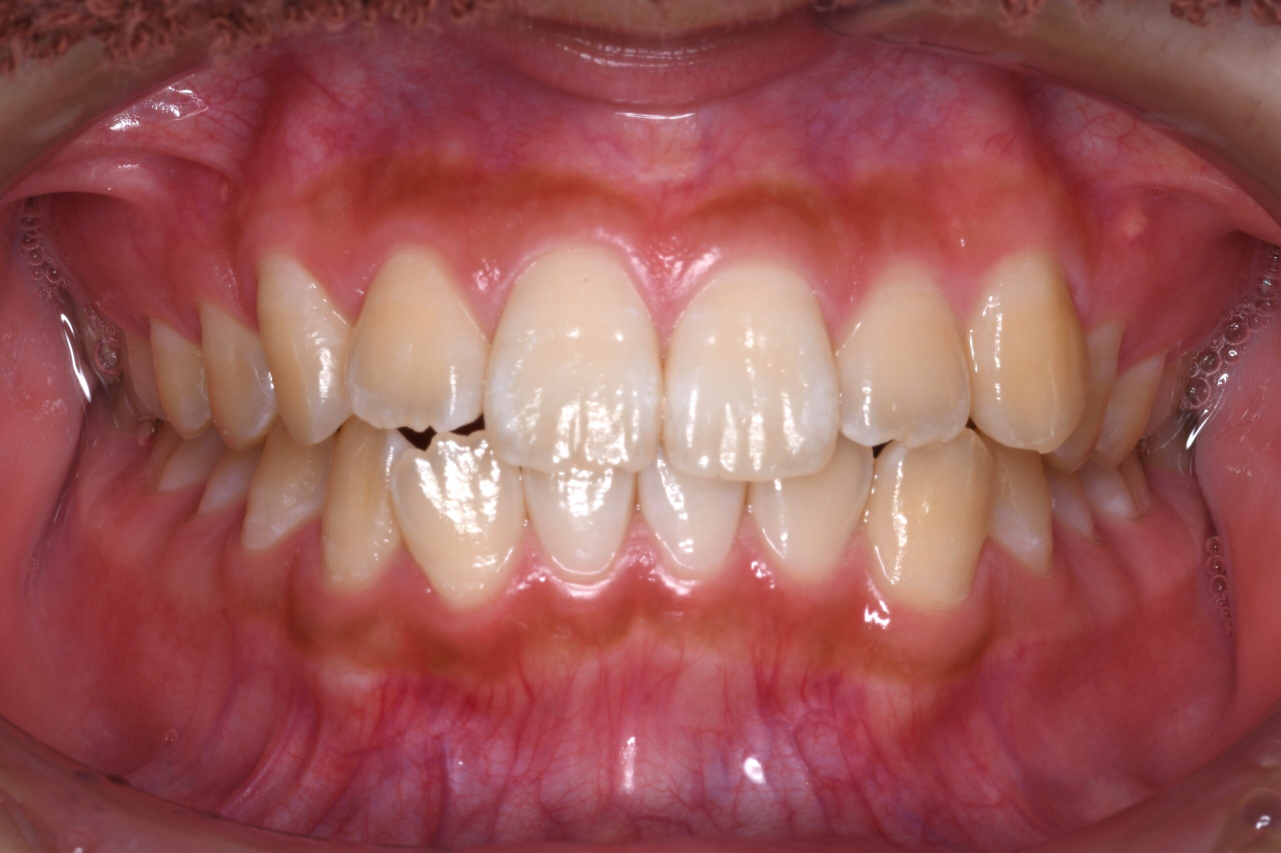 かみ合わせを治したい 治療前