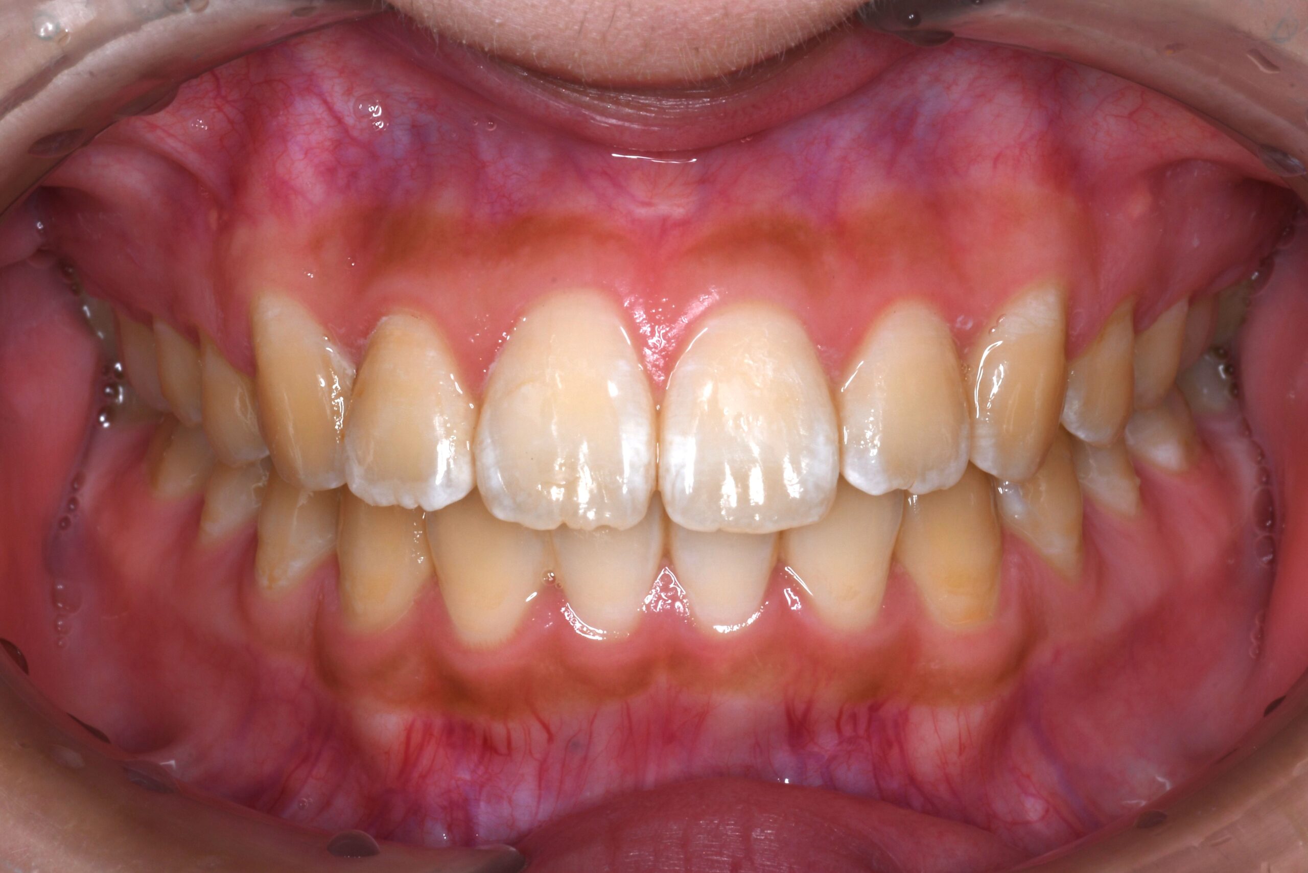 かみ合わせを治したい 治療後