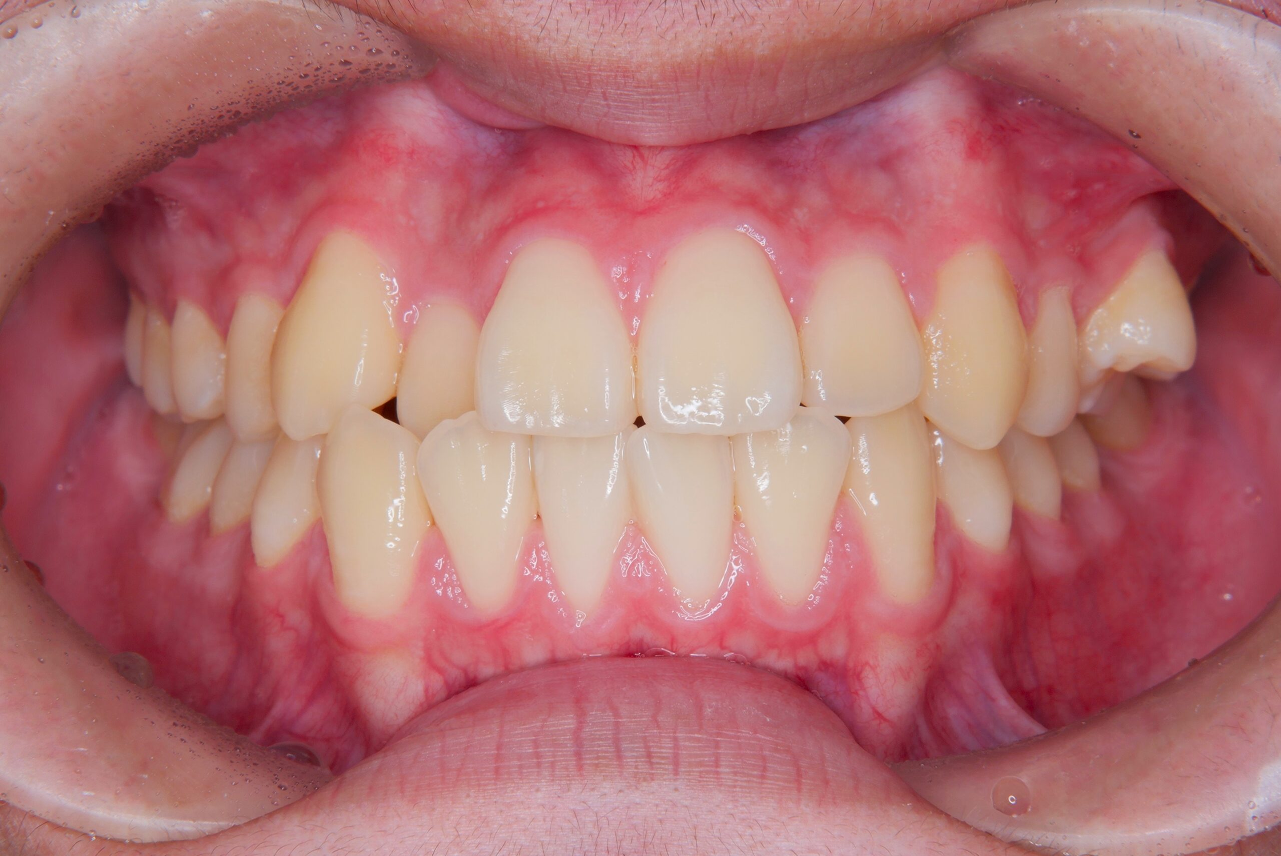 前歯のかみ合わせを治したい 治療前