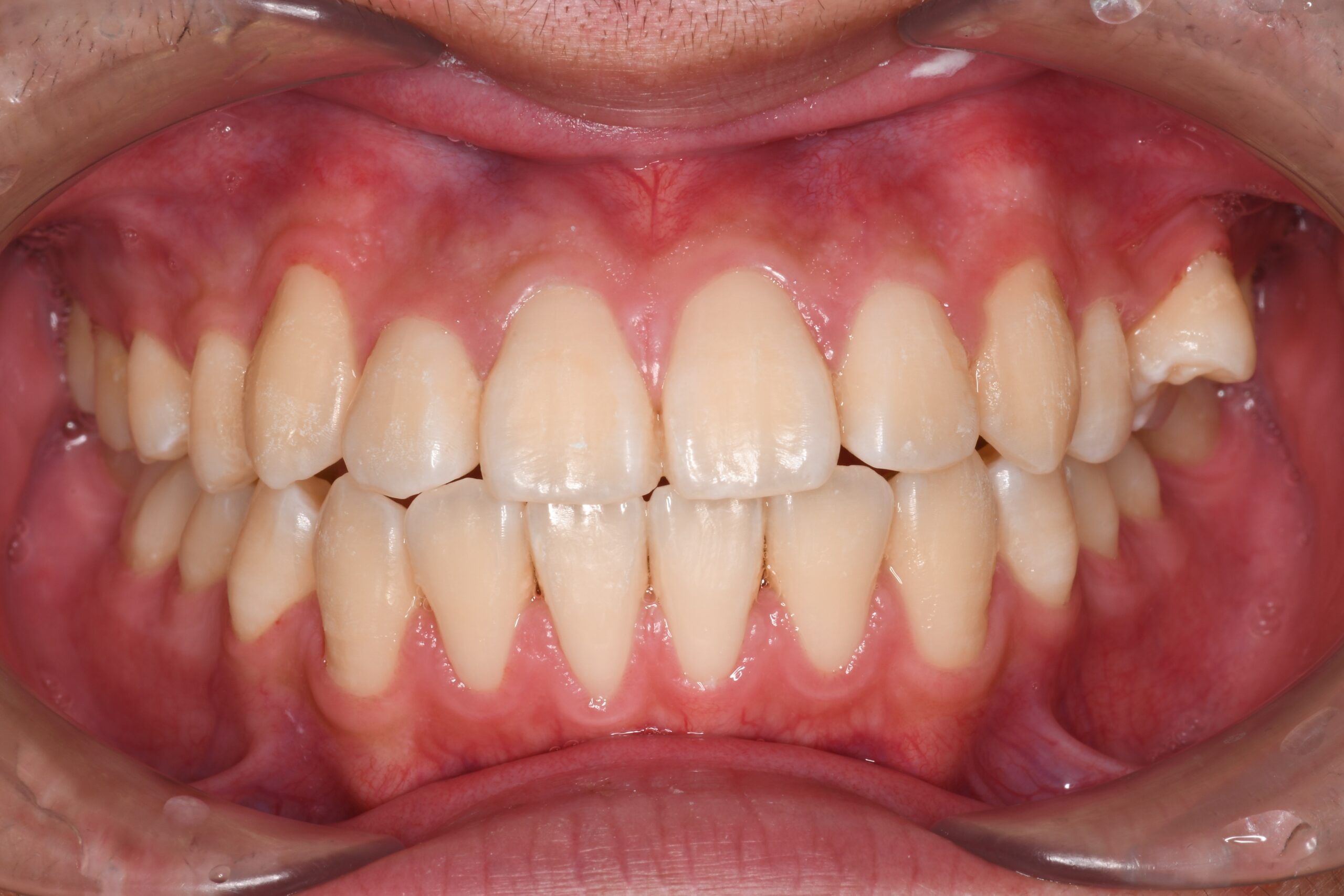 前歯のかみ合わせを治したい 治療後