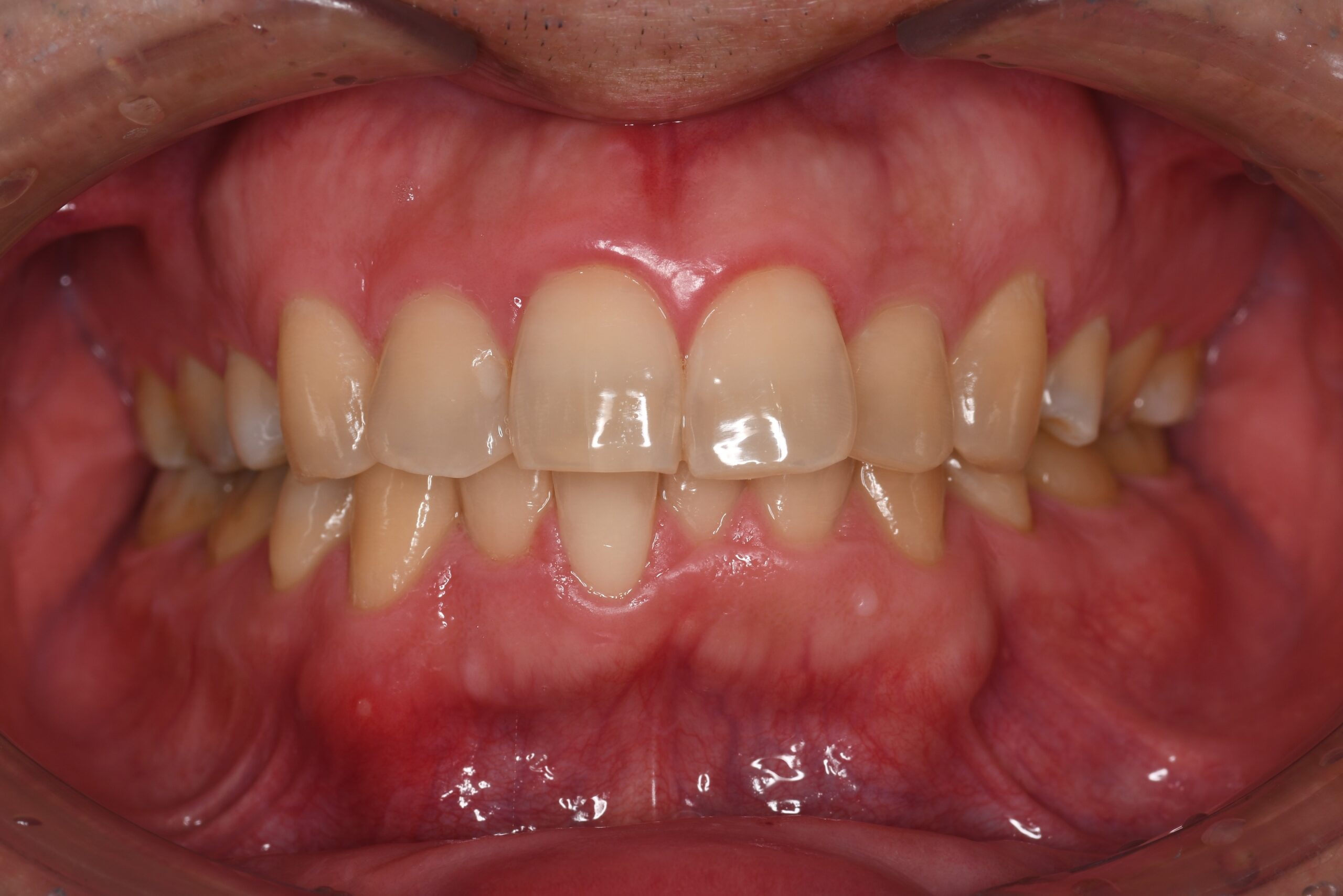 矯正治療の後戻りを治したい 治療前