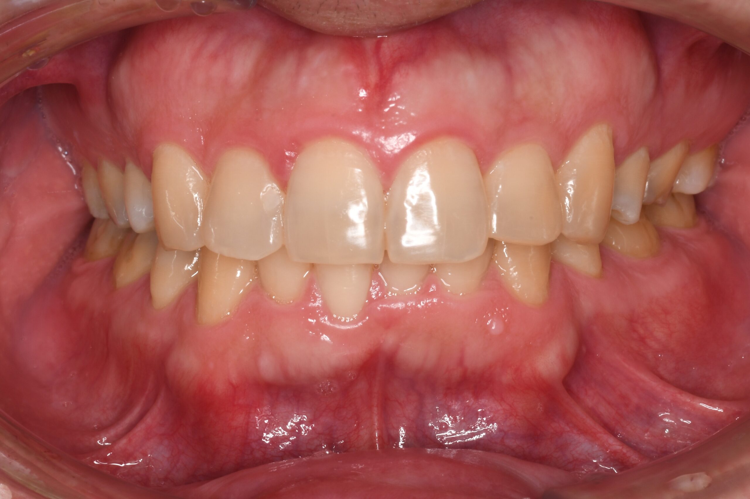 矯正治療の後戻りを治したい 治療後