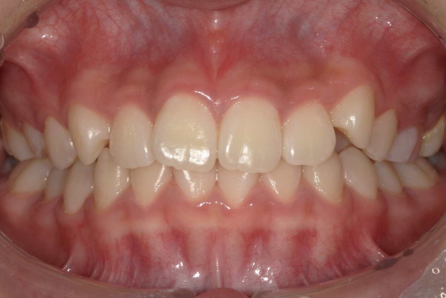 前歯の歯並びを治したい 治療前