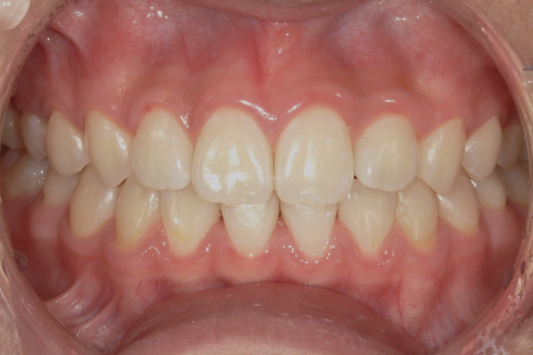 前歯の歯並びを治したい 治療後