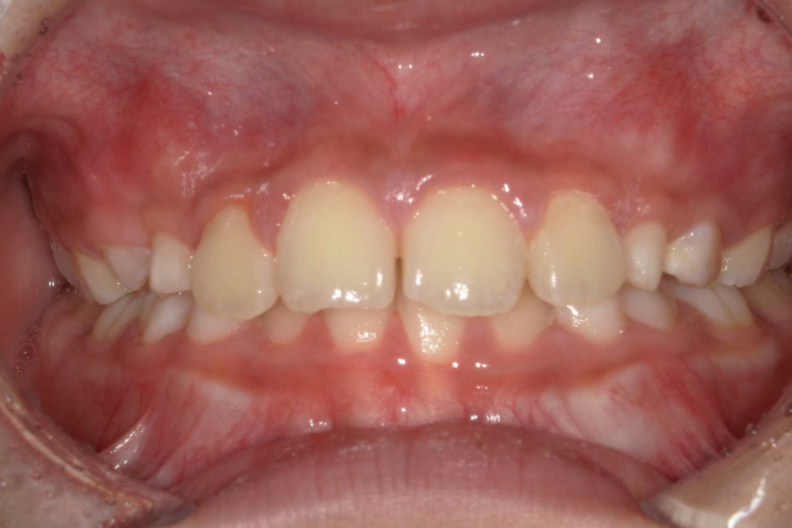 出っ歯、かみ合わせの深さを治したい 治療前