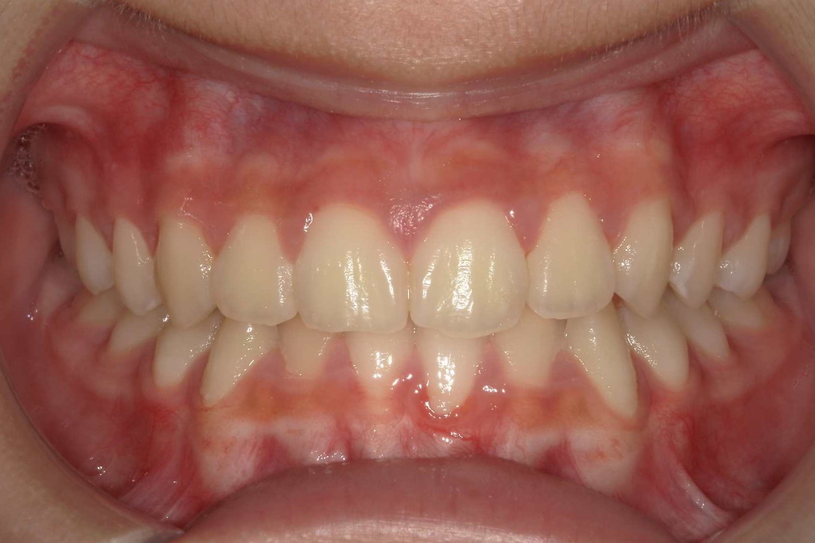 出っ歯、かみ合わせの深さを治したい 治療後