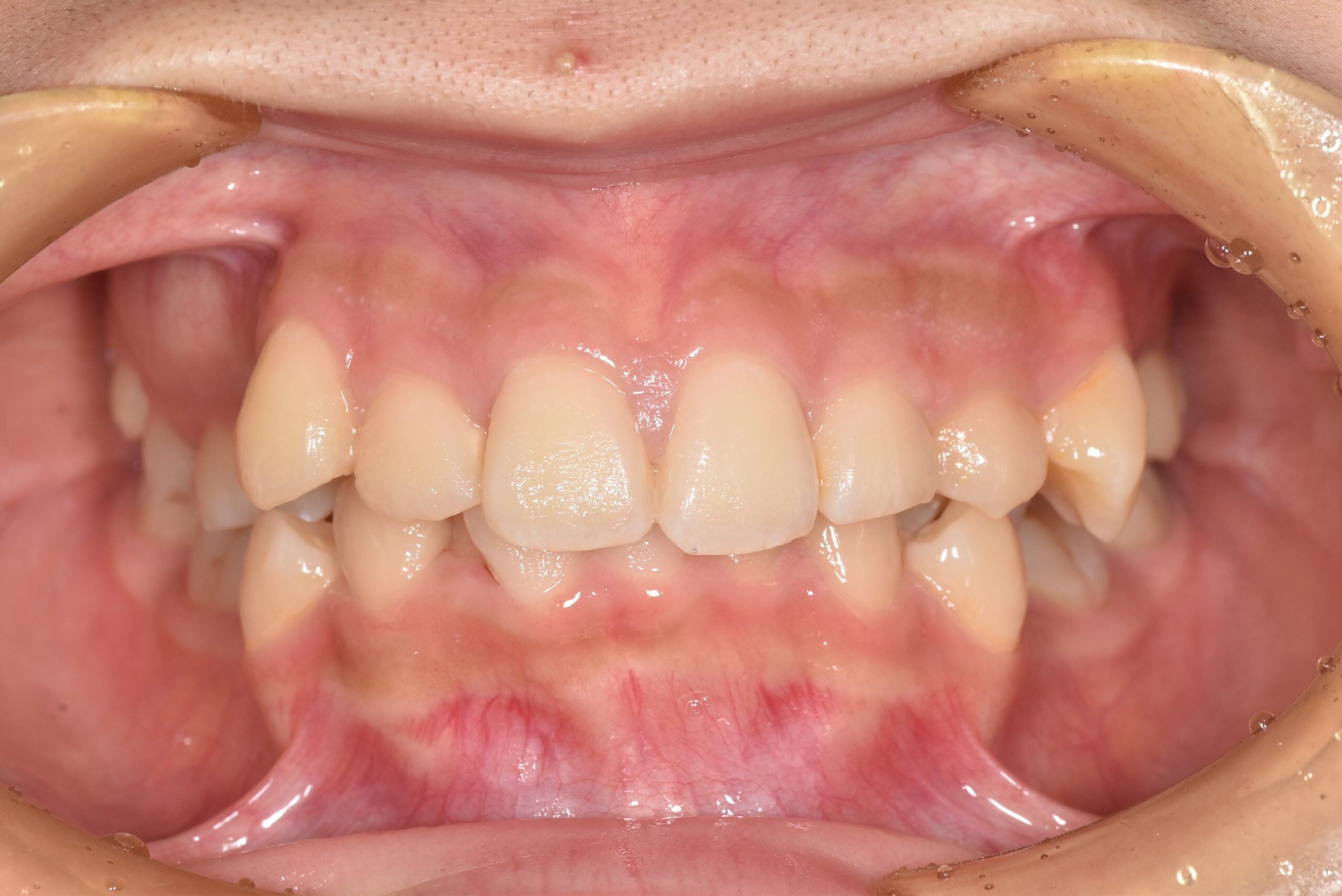 ガタガタが気になる 治療前