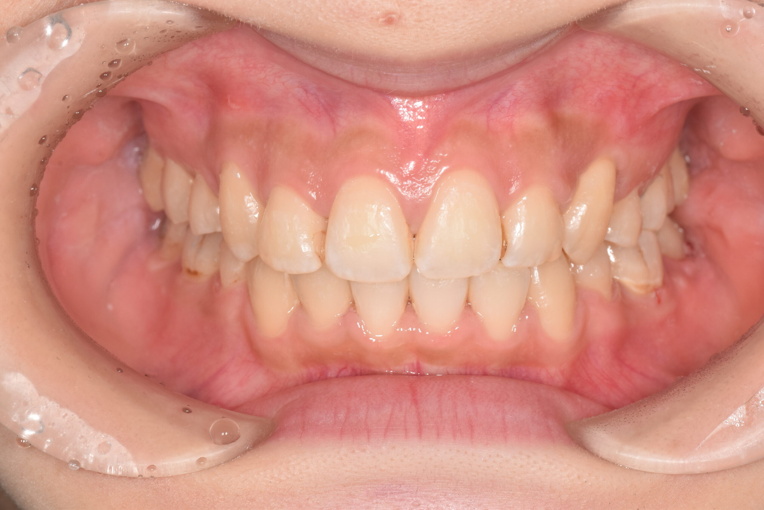 ガタガタが気になる 治療後